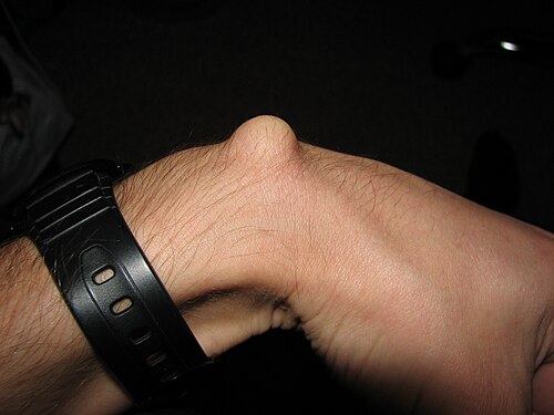 Ganglion (Überbein)